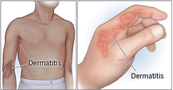 Dermatitis Atopik: Pengertian, Penyebab, dan Gejala