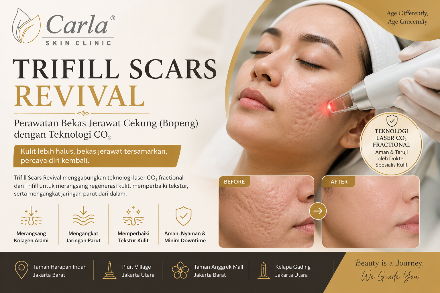 Trifill Scars Revival: Perawatan Bekas Jerawat Cekung (Bopeng) dengan Teknologi CO\u2082