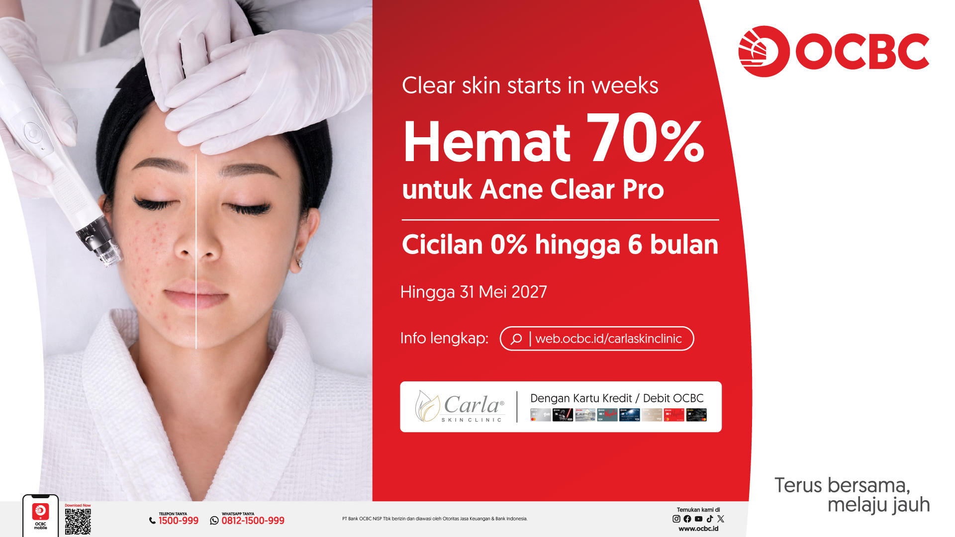 Acne Clear Pro: Hemat 70% + Cicilan 0% dengan Kartu OCBC